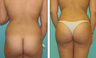 Brazilian Butt Lift Before & After
