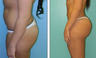 Brazilian Butt Lift Before & After