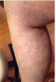 34 year old female with spider veins