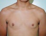 Adolescent Male treated for Breast Reduction
