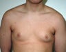 Adolescent Male treated for Breast Reduction
