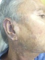 62 yo male with hemangioma face.