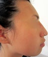 24 year-old female with nose hump treated with Restylane filler