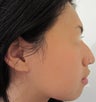 24 year-old female with nose hump treated with Restylane filler
