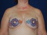 Breast Reconstruction