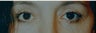 Female Patient's Before & After of an Upper & Lower Lid Blepharoplasty