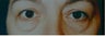 Female Patient's Before & After of an Upper & Lower Lid Blepharoplasty