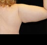 Arm Lift
