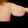 Arm Lift