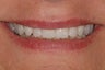 This female patiented with hopeless and missing teeth. All teeth in the top jaw were replaced with implant bridge.