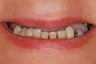 This female patiented with hopeless and missing teeth. All teeth in the top jaw were replaced with implant bridge.