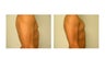 Pec Implant Augmentation