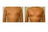 Pec Implant Augmentation
