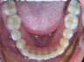 Lower crowding treated with Invisalign