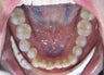 Lower crowding treated with Invisalign