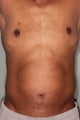 42 Year Male Treated to Increase Ab Definition