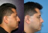 male rhinoplasty