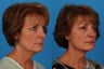 Facial Rejuvenation: 59-Year-Old Woman