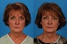 Facial Rejuvenation: 59-Year-Old Woman