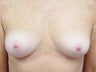 Female Patient Before and After Breast Lift