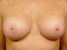Female Patient Before and After Breast Lift