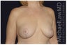 Mastopexy