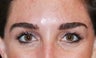 Botox 2