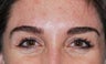 Botox 2