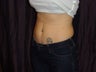Coolsculpting