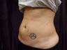 Coolsculpting