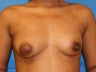 Liposuction
