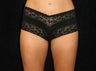 Thighplasty/Body Lift