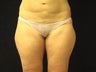 Thighplasty/Body Lift