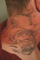 Neck Tattoo Removal -Laser Treatment