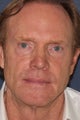 61 year old male treated with fillers