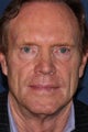 61 year old male treated with fillers
