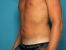 Abdominal Liposuction - male