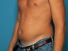 Abdominal Liposuction - male