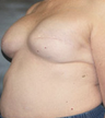 Breast Reconstruction
