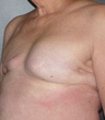 Breast Reconstruction