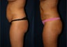 Liposuction