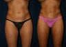Liposuction
