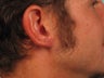Ear Lobe Reconstruction
