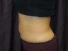 Coolsculpting