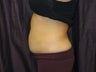 Coolsculpting