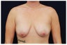 Breast Lift with Implants