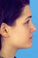 Septorhinoplasty