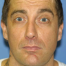 Otoplasty