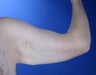 36 year old male weight loss patient with arm laxity