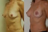 Breast Augmentation and Lift